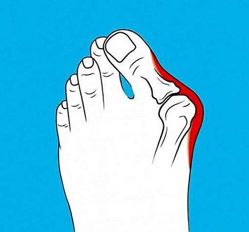 arthritis in toes
