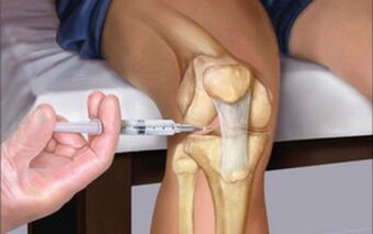 intra-articular injection into a joint to treat arthritis