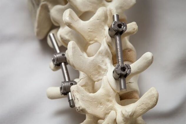 fixation of cervical spine