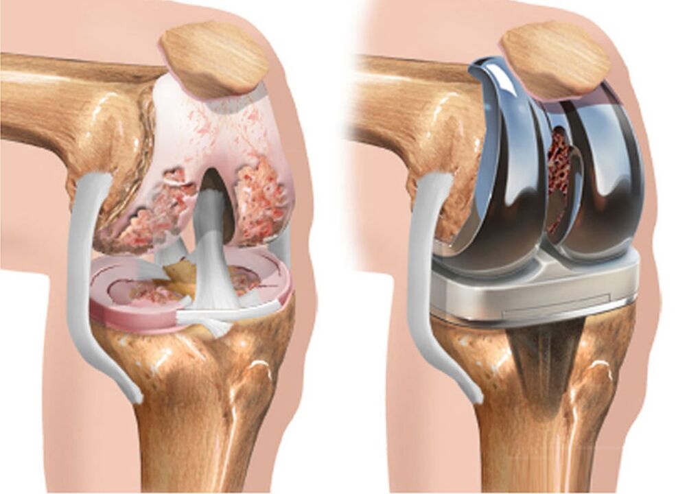 before and after dry joints of the knee joint for joint disease