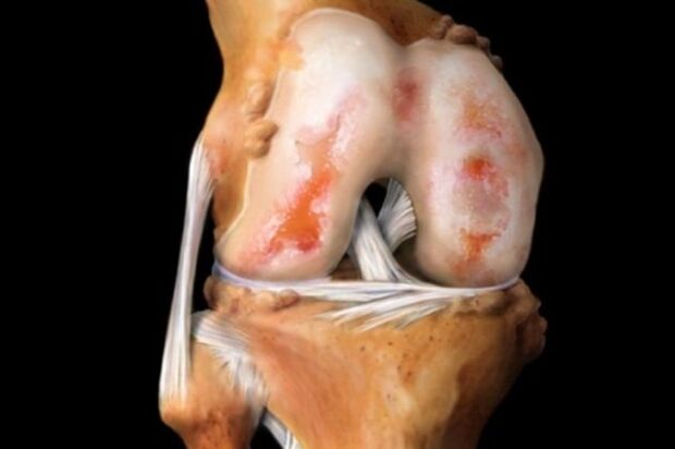 cartilage damage in arthropathy of the knee