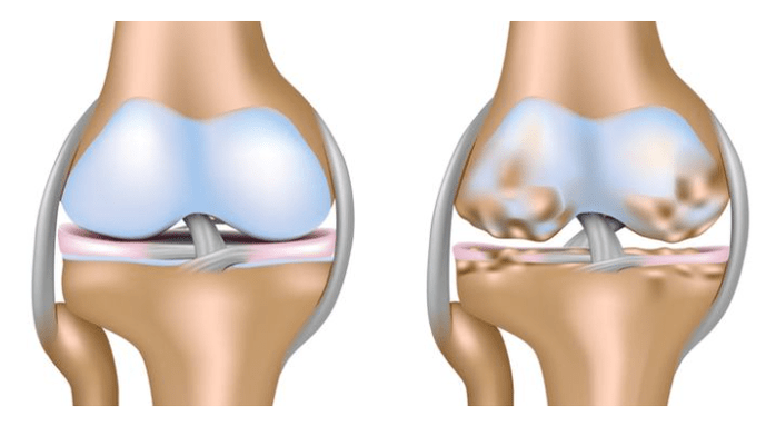 healthy cartilage and knee joint damage from arthritis