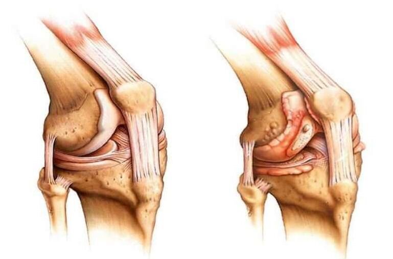 healthy knee joints and knee arthritis