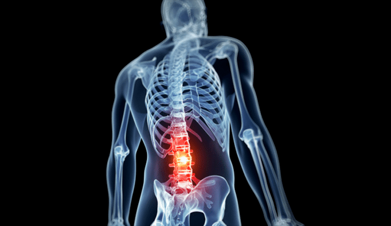 lumbar spine injury in osteonecrosis disease
