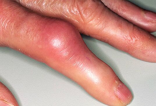 Gout is accompanied by sharp pain in the fingers and swollen joints. 