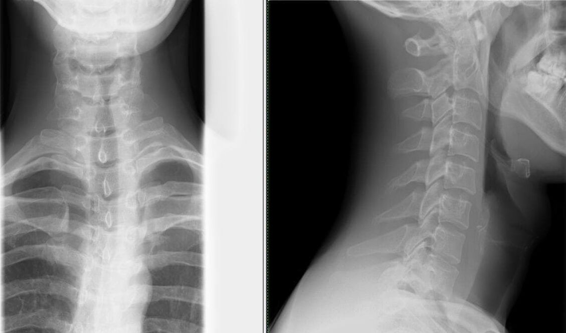 X-ray of the spine is a simple and effective method of diagnosing osteoarthritis