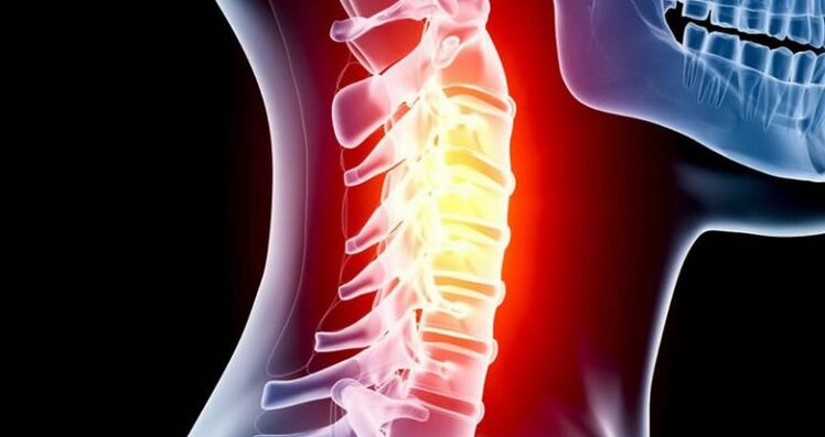 Inflammation of the cervical area