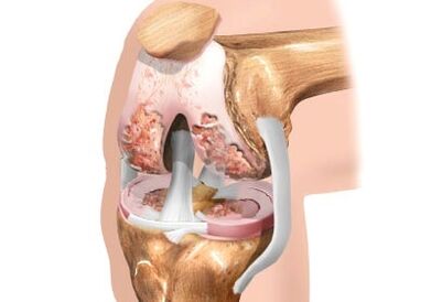 Damage to knee joint disease