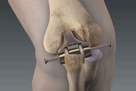 Knee replacement for arthritis