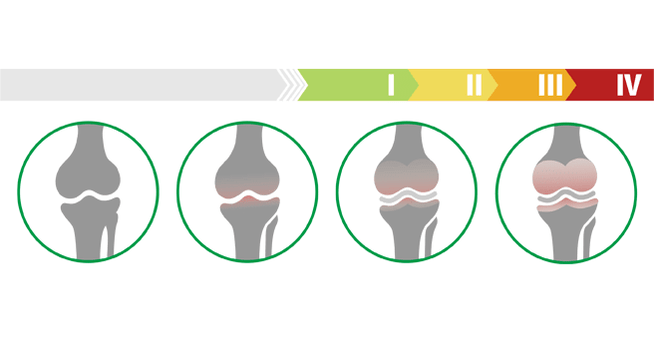 muscle atrophy stage